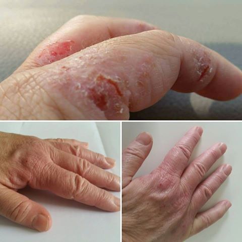 Eczema Before & After