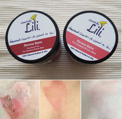 2nd Degree Burns Renew Balm