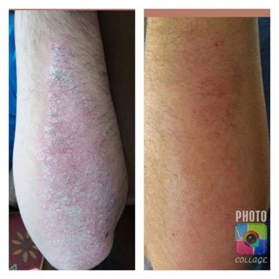 Before Psoriasis/After 1 wk Oasis Balm