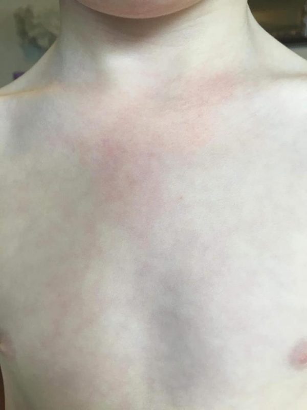 After 2nd Degree Burns