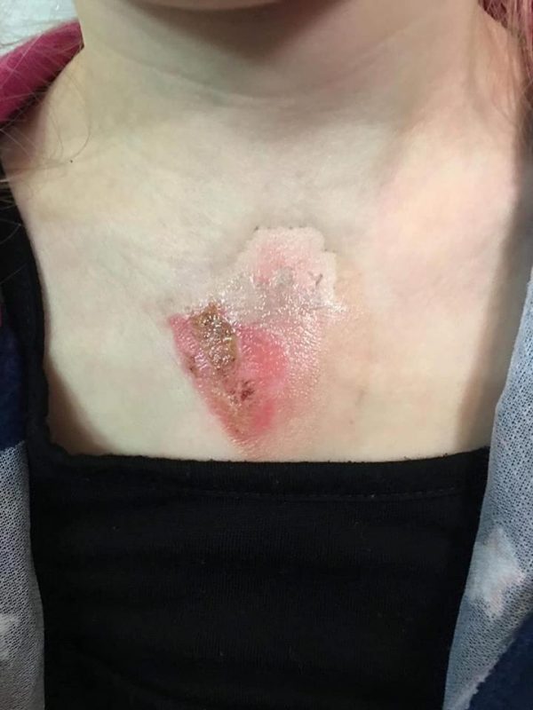 2nd Degree Burns