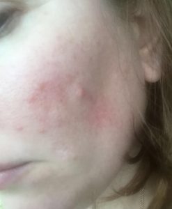 Anguish of Rosacea with Acne