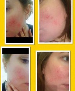 Rosacea Before & After