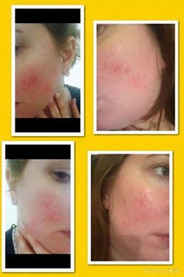Rosacea Before & After