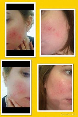 Rosacea Before & After