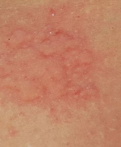 Stung by Jellyfish