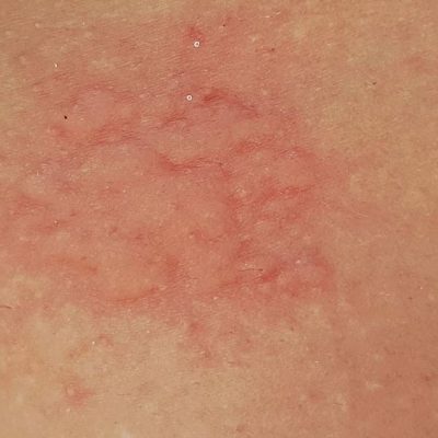 Stung by Jellyfish