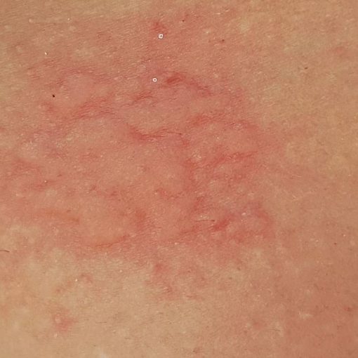 Stung by Jellyfish