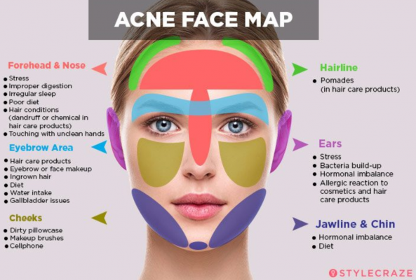 Acne Face Map Dec19
