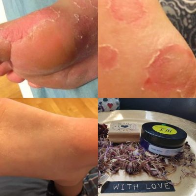 Fungal Infection Before/After Renew Balm