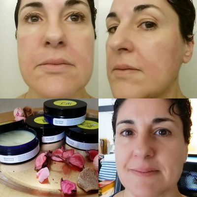 Nourishing Face Balm Before/After burning my face with Apple Cider Vinegar