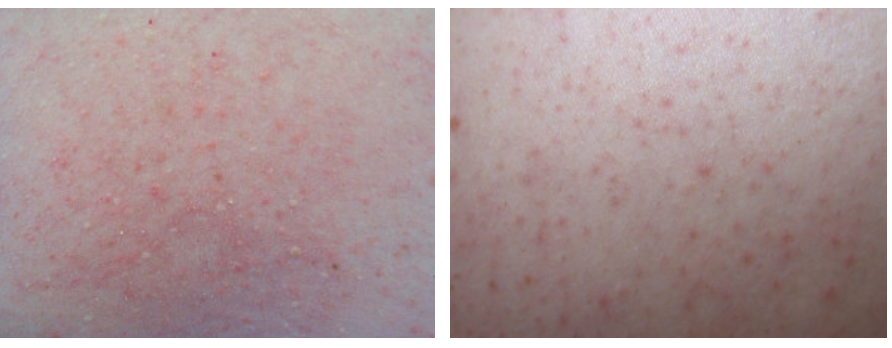 Keratosis Pilaris 1