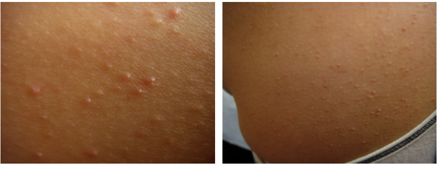 Keratosis Pilaris 2