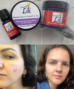 Before After Acne treatment
