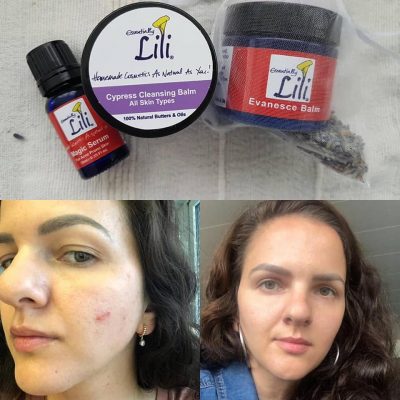 Before After Acne treatment