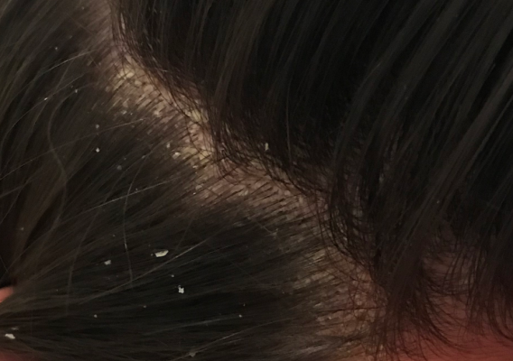 Dandruff Feb2021