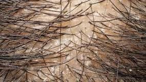 Dandruff healthline Feb2021