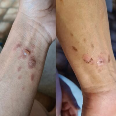 Burns Before & After 5 Days using Renew Balm Aug23